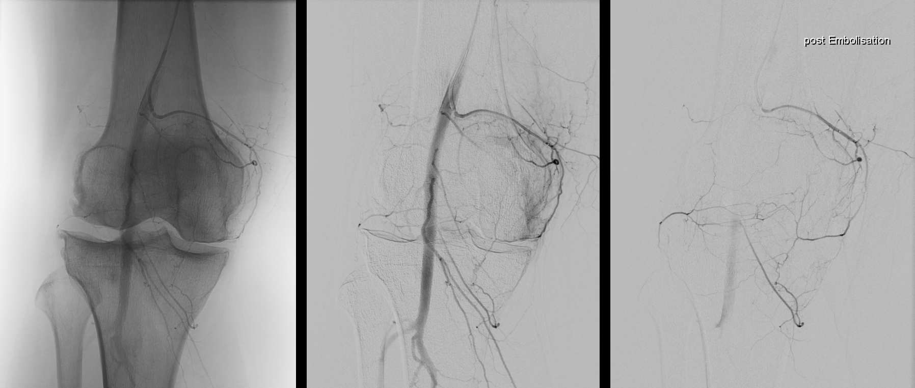 Angiographie des Kniegelenks bei transarterieller periartikulärer Embolisation (TAPE) – Gelenkembolisation Klinik Hietzing Wien